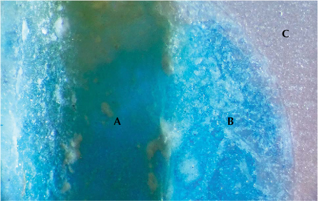 Drill hole, epoxy filling, and colorless chalcedony revealed when bead is cross sectioned. Drill hole, epoxy filling, and colorless chalcedony revealed when bead is cross sectioned.