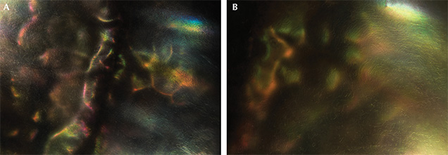 Untreated akoya pearls exhibiting iridescent and botryoidal subsurface growth.