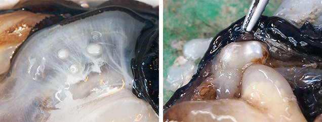 Pearls found in adjacent sacs or within the same sac