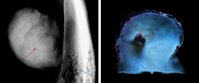 Figure 3. Left: A real-time microradiograph image showing the internal structure of the blister pearl consisting of an organic-rich core surrounded by concentric growth arcs (red arrow) with parasite holes in the host shell (blue arrow). Right: Strong orangy red reaction under long-wave UV light, observed on the edge of the shell and part of the black area on the blister pearl. Photos by Lubna Sahani (left) and Gaurav Bera (right).